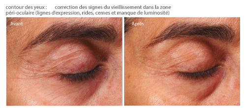 avant après radiofréquence contour des yeux avec Genesis 