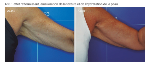 avant après radiofréquence bras avec Genesis