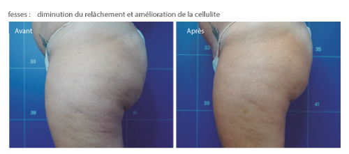 avant aprés cellulite radiofréquence